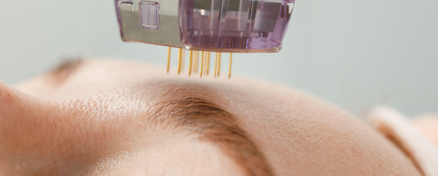 Microneedling device being used on forehead at our Birmingham clinic